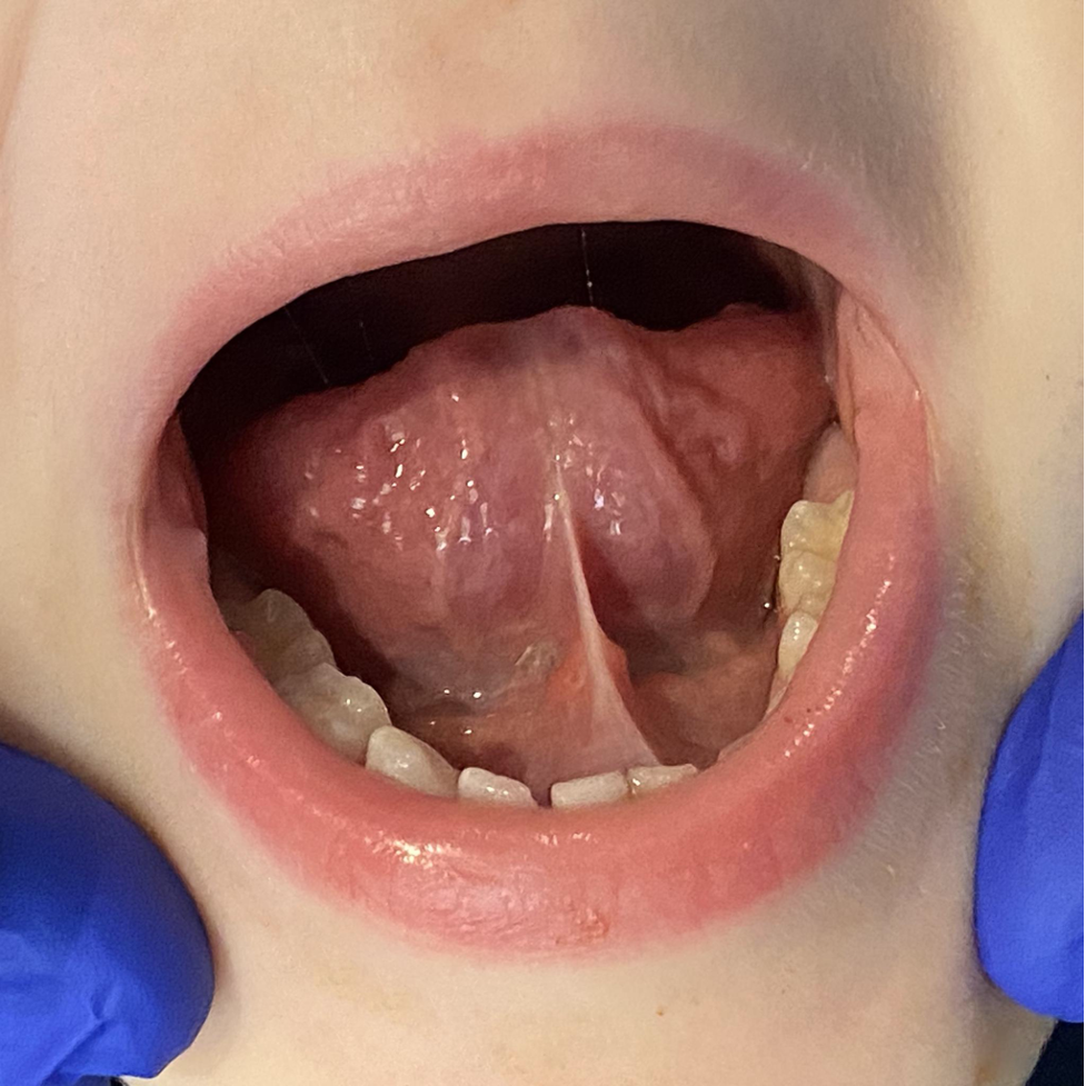 diagnosing a posterior tongue tie