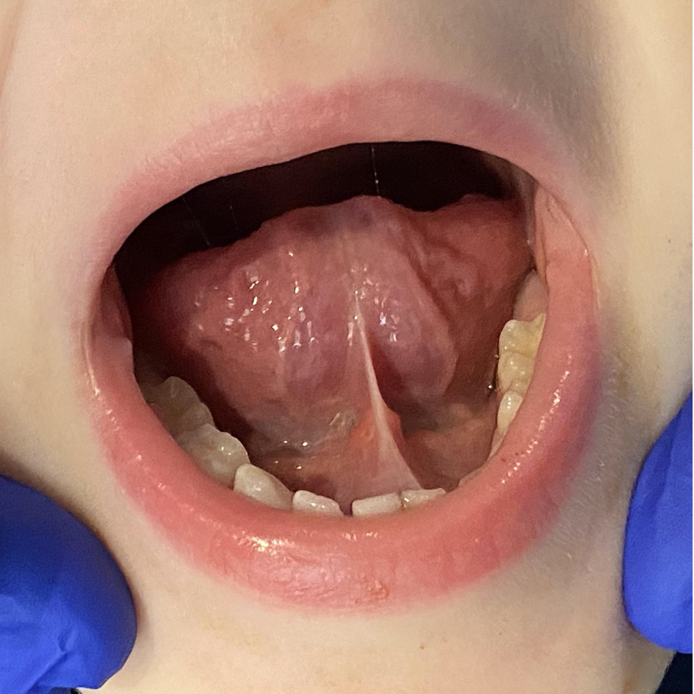 Tongue Restriction Questionnaire A New Screening Tool To Identify Tongue Tied Patients March