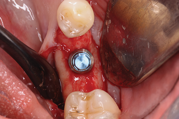 Removal of dental implants: review of five different techniques