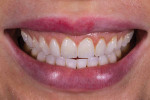 Fig 2. Pretreatment full smile photograph displaying retroclined maxillary teeth and collapsed buccal corridors.