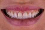 Fig 6. Full smile photograph acquired after the completion of clear aligner treatment but before the restorative treatment demonstrating how the teeth have been uprighted, the buccal corridors are fuller, and there is now room in the anterior to lengthen the teeth.