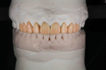 Fig 7. Analog wax-up of the smile design of teeth Nos. 4 through 13 (designed by Myung Joo Shin at Synergy Ceramics).