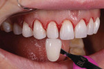 Fig 9. Tissue recontouring and crown lengthening were performed to achieve ideal gingival scalloping and heights, and the teeth were barely prepared, which resulted in an all-enamel substrate and bright color.