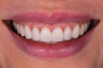 Fig 10. Provisional restorations (Luxatemp [Bleach Light], DMG America) were placed to permit assessment of the new tooth and tissue alterations in the smile.