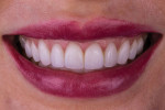 Fig 16. Posttreatment full smile photograph demonstrating a longer, fuller smile with proper function.