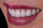 Fig 17 and 18. Posttreatment right and left lateral smile photographs.