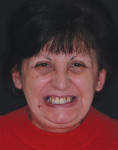 (1.) Pretreatment full face patient portrait showing malpositioned teeth and deviation of the dental midline. Note the excessive contact between the patient’s maxillary anterior teeth and the vermillion of her lower lip in maximum smile.