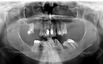 (3.) Pretreatment panoramic radiograph evidencing bone loss and advanced pneumatization of the sinus cavities.