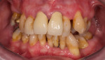 (2.) Pretreatment retracted view showing clinical attachment loss, soft-tissue recession, and the presence of staining and tartar.