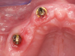 (11.) Left-side and right-side occlusal close-up views of the maxillary multi-unit abutments and an occlusal view of the mandibular multi-unit abutments, respectively, following a 4-month healing period. Adequate plaque control allowed the patient to maintain healthily peri-implant tissues and stable marginal bone levels.