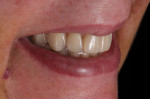 (10.) Postsurgical right lateral smile photograph demonstrating the new esthetics and function that were provided with the immediate prostheses.