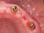 (12.) Left-side and right-side occlusal close-up views of the maxillary multi-unit abutments
and an occlusal view of the mandibular multi-unit abutments, respectively, following a 4-month healing period. Adequate
plaque control allowed the patient to maintain healthily peri-implant tissues and stable marginal bone levels.