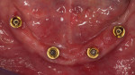 (13.) Left-side and right-side occlusal close-up views of the maxillary multi-unit abutments
and an occlusal view of the mandibular multi-unit abutments, respectively, following a 4-month healing period. Adequate
plaque control allowed the patient to maintain healthily peri-implant tissues and stable marginal bone levels.