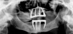 (19.) A panoramic radiograph and 
 periapicalradiographs were acquired to verify the seating of the aluminum indexes.