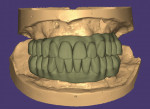 (22.) The prototypes were scanned with a desktop scanner, and the design of the definitive prostheses was finalized by the dental technician.