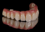 (23.) Extraoral views of the final layered full-arch zirconia prostheses that were milled without titanium bases. The facial aspects of the teeth were customized with feldspathic porcelain to personalize the esthetics.