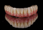 (24.) Extraoral views of the final layered full-arch zirconia prostheses that were milled without titanium bases. The facial aspects of the teeth were customized with feldspathic porcelain to personalize the esthetics.