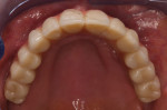 (26.) Maxillary and mandibular occlusal views of the final prostheses with distal cantilevers 
 imited to the first molars.