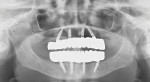 (30.) Final panoramic radiograph of the definitive prostheses acquired on the day of delivery.