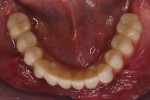 (27.) Maxillary and mandibular occlusal
views of the final prostheses with distal cantilevers limited to the first molars.