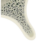 (1.) Illustrations showing how the barbell technique is used in bidirectional horizontal bone augmentation, including views of the initial horizontal bone defect with buccal and palatal bone loss, the barbell screw transecting the alveolar ridge from the buccal to palatal aspects, the PEEK caps connected to the screw heads, and the bone graft biomaterial applied both buccally and palatally and covered by an occlusive collagen membrane.