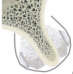 (4.) Illustrations showing how the barbell technique is used in bidirectional horizontal bone augmentation, including views of the initial horizontal bone defect with buccal and palatal bone loss, the barbell screw transecting the alveolar ridge from the buccal to palatal aspects, the PEEK caps connected to the screw heads, and the bone graft biomaterial applied both buccally and palatally and covered by an occlusive collagen membrane.