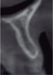 (5.) CBCT scans acquired before and after reconstruction with the barbell technique concept.