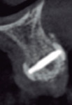 (6.) CBCT scans acquired before and after reconstruction with the barbell technique concept.