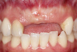 (7.) Pretreatment retracted close-up view of the patient’s partially edentulous anterior maxilla.