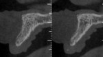 (8.) Pretreatment CBCT scan showing significant horizontal bone loss.