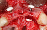 (9.) Placement of the screws and PEEK caps for the barbell technique. Note the need for bidirectional horizontal bone augmentation on the left side, where a screw that was 10 mm in length was used, and the need for unidirectional horizontal bone augmentation (ie, buccal ) on the right side, where a shorter screw that was 8 mm in length was used.