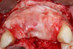 (11.) A bovine xenograft material was placed, followed by a collagen membrane, and then the site was sutured closed.