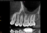 Fig 5. CBCT, sagittal view, showing apical PDL widening and mesial crestal bony defect.