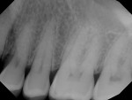 Fig 6. Preoperative periapical
radiograph of tooth No. 14.