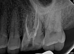 Fig 7. Postoperative periapical radiograph of tooth No. 14 depicting treatment following Davis and Shariff’s protocol,
including placement of a deep intraorifice barrier and occlusal reduction.