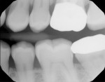 Fig 8. Bitewing radiograph showing well-adapted zirconia crown on
tooth No. 14. At the time of this writing, this case was awaiting a 6-month follow-up in May 2024.