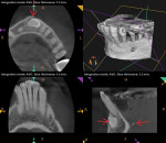 Fig 3. Limited FOV CBCT
imaging of the anterior mandible revealed evidence of pre-eruptive intracoronal resorption occurring in the coronal portion of the impacted canine
(red arrows pointing down and to the right), positioned in the facial bone adjacent to mandibular incisors. A radiopacity in the soft tissues lingual to
the mandibular bone was suspicious for a sialolith (red arrow pointing left) and clinically correlated to a history of pain while eating, which required
massaging to relieve. Referral was made to an OMFS for the workup of these two issues.