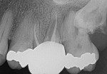 Fig 4 and Fig 5. Periapical imaging showing teeth Nos. 13
through 16 in partial view. Periapical pathology associated with tooth No. 15 was present. The impacted tooth No. 16 was seen to have a prominent
radiolucency in its coronal aspect; however, significant anatomic noise rendered the imaging non-diagnostic in this region.