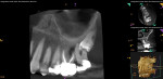 Fig 6 and Fig 7. CBCT
imaging of the maxillary left posterior showing periapical pathology extending beyond tooth No. 15 to involve the distobuccal and palatal roots of
tooth No. 14. Clear evidence of pre-eruptive intracoronal resorption was noted within tooth No. 16, and evidence of pressure resorption affecting
the distobuccal and palatal roots of tooth No. 15 appeared secondary to the positioning of tooth No. 16 in close proximity. Generalized maxillary
sinus mucositis was noted adjacent. Fig 6: Sagittal section, buccal roots Nos. 14 through 16. Fig 7: Sagittal section, palatal roots Nos. 14 through 16.