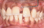 Fig 2. Preoperative intraoral photograph of patient.