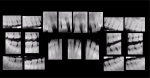 Fig 5. Preoperative full-mouth radiographic series.