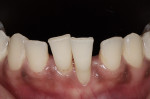 Fig 6. Preoperative clinical view of mandibular anterior teeth depicting lack of attached gingiva at tooth No. 24 and recession at teeth Nos. 24 and 25.