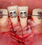 Fig 7. Stabilization of free gingival graft on the facial surface of teeth Nos. 24 and 25.