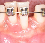 Fig 8. At 2 weeks postoperative after free gingival graft procedure, note gain of attached tissue.