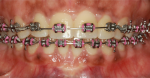 Fig 9. At 1 year postoperative, note alignment of maxillary and mandibular incisors and correction of gingival defect.