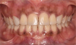 Fig 10. Clinical photograph of patient 5 years postoperative after completion of orthodontic treatment.