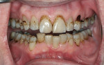 Fig 1. Pretreatment retracted view showing extensive discoloration, multiple carious lesions, and leaky composite restorations.