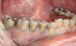 Fig 6. Class 5 preparations after removal of the caries and old restorative material from the mandibular right quadrant.