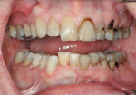 Fig 7. Immediate postoperative view after placement of the one-shade flowable and universal composites in the mandibular right quadrant, 1 week after treatment of the maxillary right quadrant.