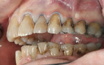 Fig 8. Class 5 preparations after removal of the caries and old restorative material from the maxillary left quadrant.